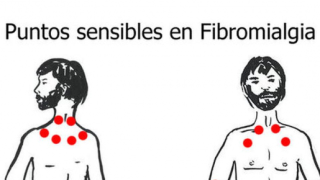 La fibromialgia viene individuata attraverso i tender points.
