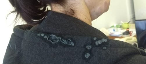 V&iacute;tima teve queimaduras no pesco&ccedil;o. (Reprodu&ccedil;&atilde;o/ Arquivo Pessoal)