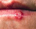 El herpes genital es una infección viral reincidente
