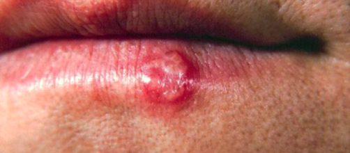 El herpes bucal se contagia f&aacute;cilmente. - merckmanuals.com
