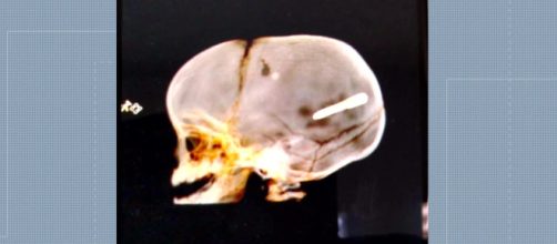 Crian&ccedil;a ficou com objeto alojado no cr&acirc;nio. (Reprodu&ccedil;&atilde;o)