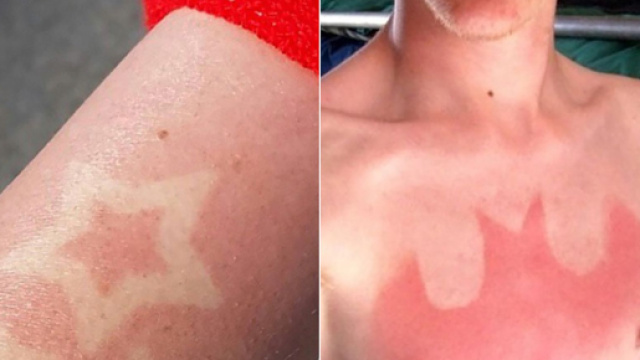 Sunburn tattoos' are the uncool way to show skin this summer HOTnews - hotnews.cx