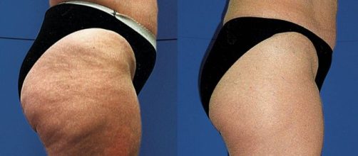 La celulitis en las piernas es una de las m&aacute;s comunes. - aprendeme.com