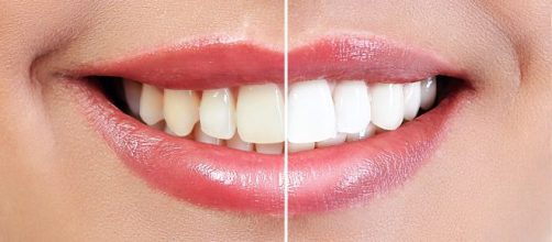 Alguns alimentos s&atilde;o prejudiciais para quem passou por procedimento de clareamento dental. (Arquivo Blasting News)