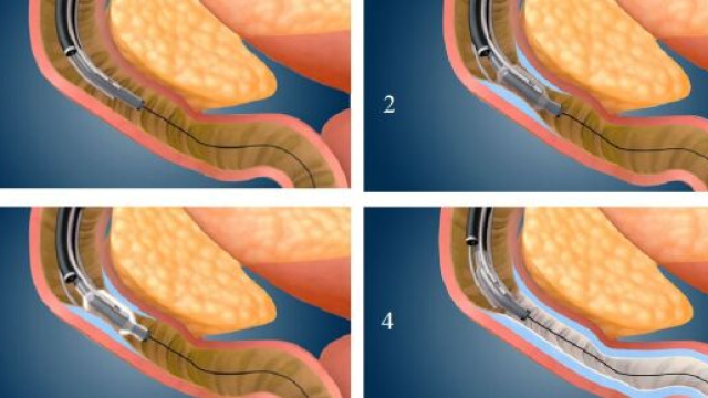 La procedura Fractyl DMR consente di effettuare un&rsquo;ablazione idrotermica della mucosa duodenale con effetti positivi e permanenti sul diabete.