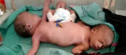 G&ecirc;meas siamesas nascem com duas pernas e quatro bra&ccedil;os. (Arquivo Pessoal)