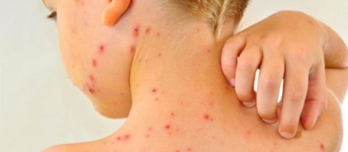 El sarampi&oacute;n resurge con un 30 % m&aacute;s de casos detectados en todo ... - com.ar