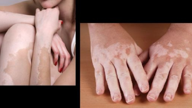 La ricerca continua a studiare la vitiligine, una malattia cronica della pelle, non congenita.