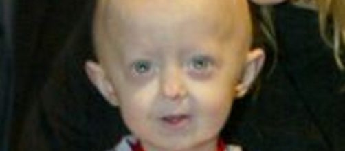 Menina de 8 anos de idade morre de velhice por sofrer com doen&ccedil;a rara. ( Arquivo Blasting News )