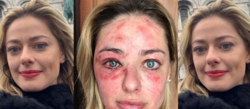 Maria Antonia, do MasterChef 2018, desabafou com os seguidores ap&oacute;s se acidentar. (Reprodu&ccedil;&atilde;o/Instagram)