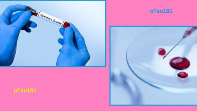 Individuato nel plasma un biomarker associato all&rsquo;Alzheimer. Questo potrebbe consentire una diagnosi precoce e non invasiva della malattia.