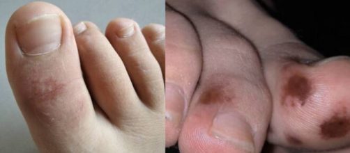 Lesiones en la piel causadas por el coronavirus. / Fayer-Wayer