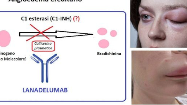 Lanadelumab &egrave; un anticorpo, ora disponibile anche in Italia, indicato in una patologia rara, che genera gonfiori sulla pelle e sulle mucose.