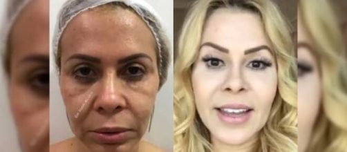 Joelma decidiu passar pelo procedimento de harmoniza&ccedil;&atilde;o facial. (Arquivo Blasting News)