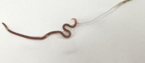 Lombriga &eacute; encontrada em am&iacute;gdala de mulher. (Divulga&ccedil;&atilde;o/The American Society of Tropical Medicine and Hygiene)