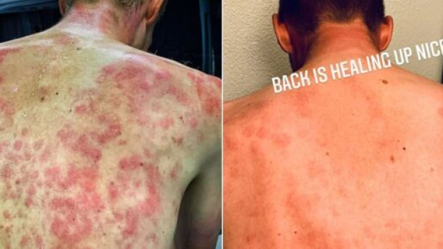 Giro del Delfinato: la schiena di alcuni ciclisti dopo l'arrivo.