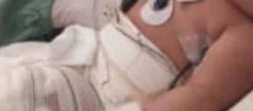 Beb&ecirc; teve 37,5% do corpo queimado em hospital. (Reprodu&ccedil;&atilde;o/Arquivo Pessoal)