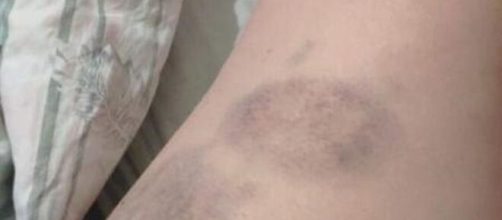 V&iacute;tima ficou com marcas roxas nas pernas. (Reprodu&ccedil;&atilde;o/Arquivo Pessoal)