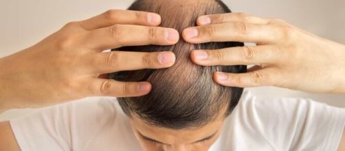 A calvice n&atilde;o &eacute; um problema exclusivo dos homens. (Arquivo Blasting News)