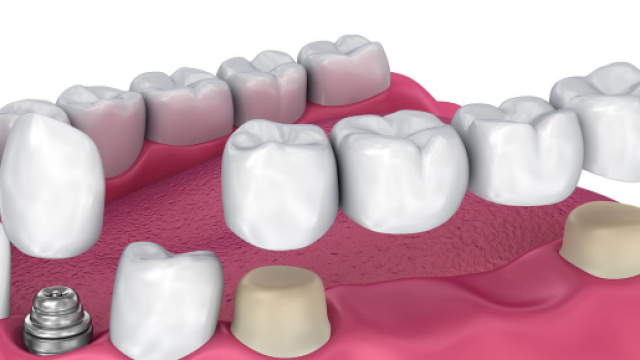 Capsule dentali: quali sono i migliori materiali e come scegliere.