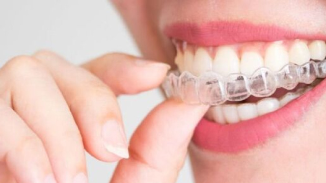 Come togliere e pulire gli apparecchi invisibili per i denti.