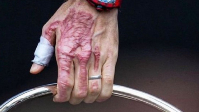 Romain Grosjean poste une photo incroyable de sa main br&ucirc;l&eacute;e (Instagram et Twitter Romain et Marion Grosjean)