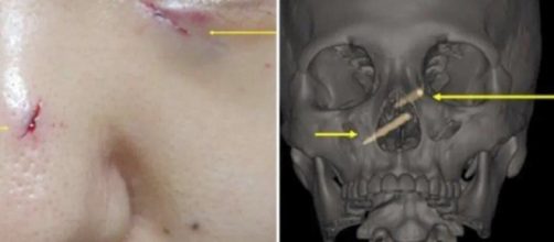 Captura de pantalla de las lesiones que presentaba una mujer que ten&iacute;a unos palillos chinos incrustados.