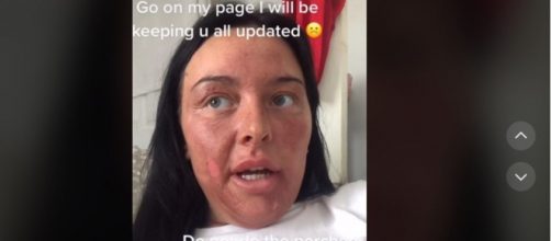 La influencer ha estado compartiendo el proceso de cicatrizaci&oacute;n (TikTok @chantelleconway2020)