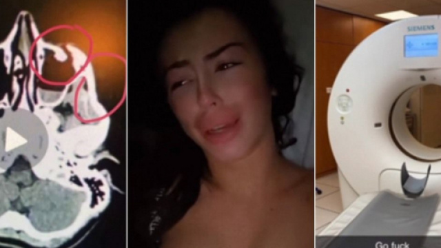 Battue et d&eacute;figur&eacute;e par son ex, Dita Istrefi, qui doit se faire op&eacute;rer en urgence, raconte ce qu'il s'est pass&eacute;.