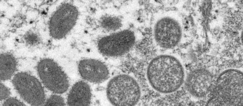 Monkeypox, identificato il primo caso di vaiolo delle scimmie in Italia