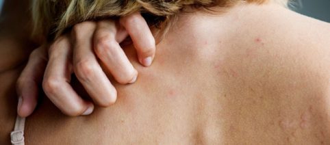 Prurito, la proteina Piezo 1 ne potrebbe essere un 'interruttore'