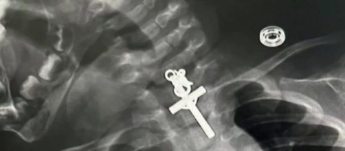 Los m&eacute;dicos tuvieron que esperar 6 horas para sacar el crucifijo (Facebook, Seguro Social de Salud del Per&uacute; - EsSalud)