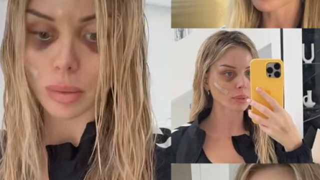 Jessica Thivenin apr&egrave;s sa derni&egrave;re op&eacute;ration de lifting. Screenshot story Instagram @jessicathivenin