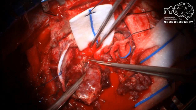 Rimozione del meningioma convessit&agrave; di grado 2 - SurgSchool &copy; Creative Commons