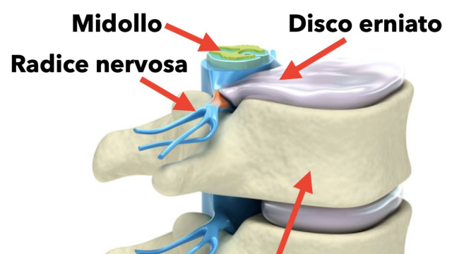 Ernia discale: terapia medica o chirurgia ? - Dott. Massimo Rossato &copy; Creative Commons