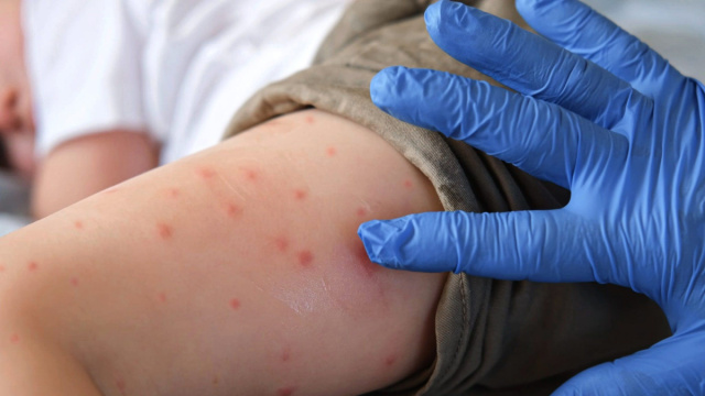 Chikungunya, caso confermato a Pisa: scatta la disinfestazione ... &copy; Creative Commons