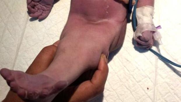 Assista: M&eacute;dicos ficam impressionados com nascimento de 'beb&ecirc; sereia'