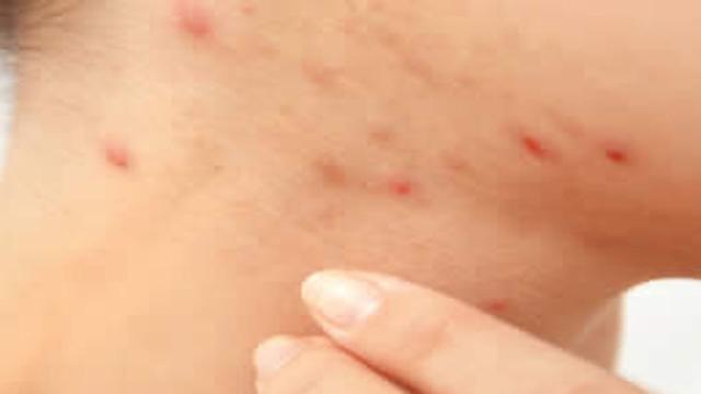 I foruncoli: ecco come si formano e da cosa dipendono