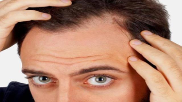 Addio calvizie: la carbossiterapia metodo efficacie 