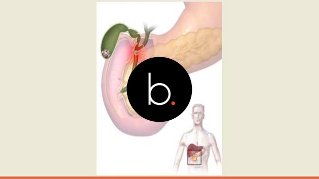 Salute: ecco i rimedi per contrastare l'insorgenza della diverticolite