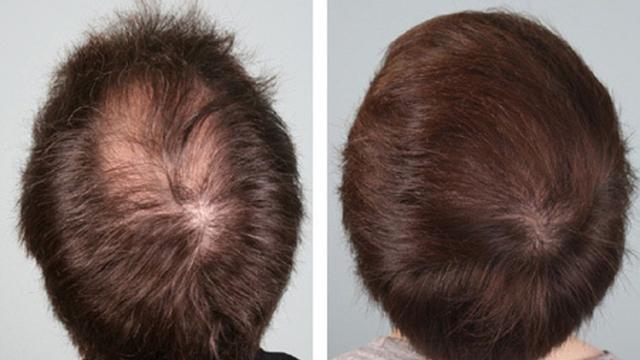 Perdita di capelli e calvizia: ecco quale meccanismo ne restituisce la vitalità