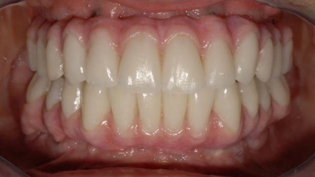 Protesi dentali fasulle, ecco come difendersi