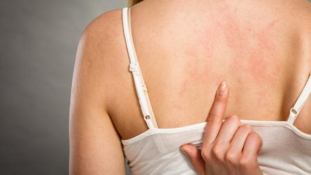 Confira o mais novo tratamento para dermatite atópica