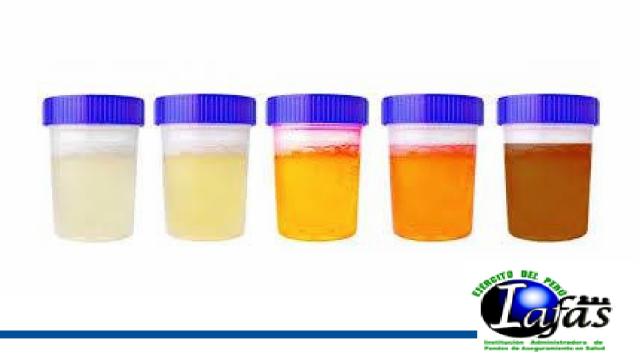 El color de la orina puede indicarle la gravedad de su salud