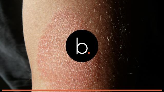 Alimentos que ajudam a amenizar a dermatite