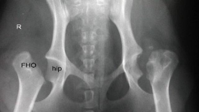 VÍDEO: Necrosis aséptica de la cabeza y cuello femoral
