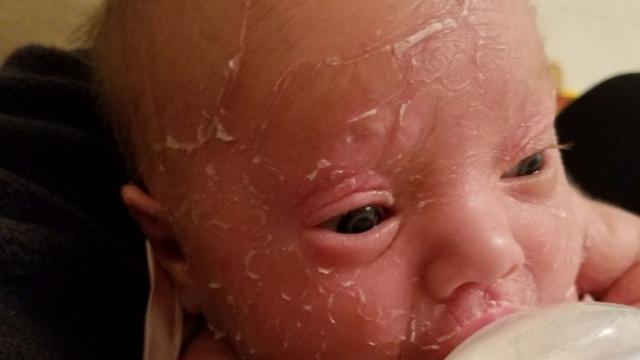 Ittiosi lamellare, la malattia rara della 