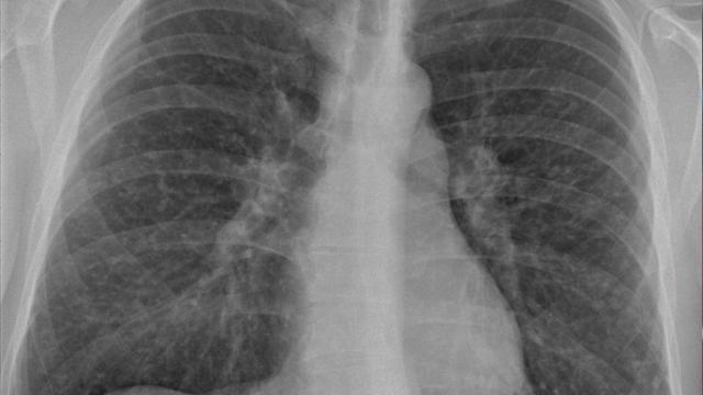 Une maladie aux causes inconnues : la sarcoïdose