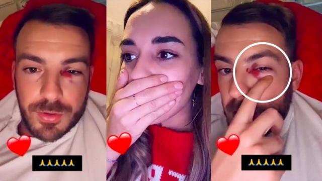 Julien Bert blessé par Hilona, il dévoile un impressionnant œil au beurre noir