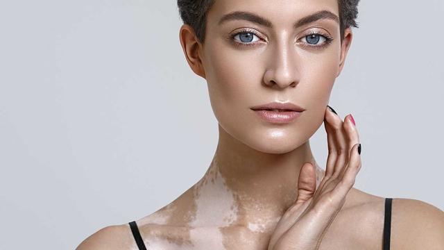 Per chi soffre di vitiligine scoperta una combinazione di microneedling e tacrolimus